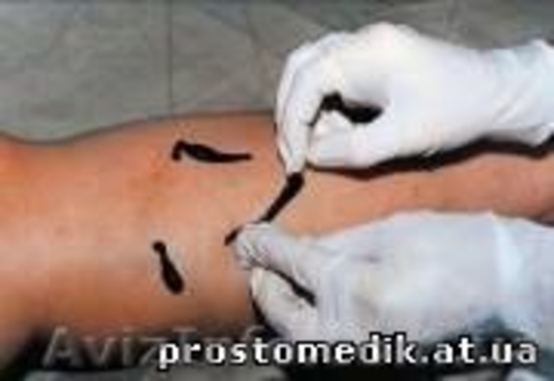 Лечение пиявками женских заболеваний c выездом к пациенту - <ro>Изображение</ro><ru>Изображение</ru> #8, <ru>Объявление</ru> #244106