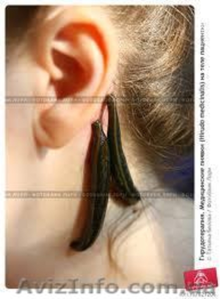 Лечение пиявками женских заболеваний c выездом к пациенту - <ro>Изображение</ro><ru>Изображение</ru> #6, <ru>Объявление</ru> #244106