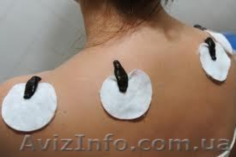 Лечение пиявками женских заболеваний c выездом к пациенту - <ro>Изображение</ro><ru>Изображение</ru> #4, <ru>Объявление</ru> #244106